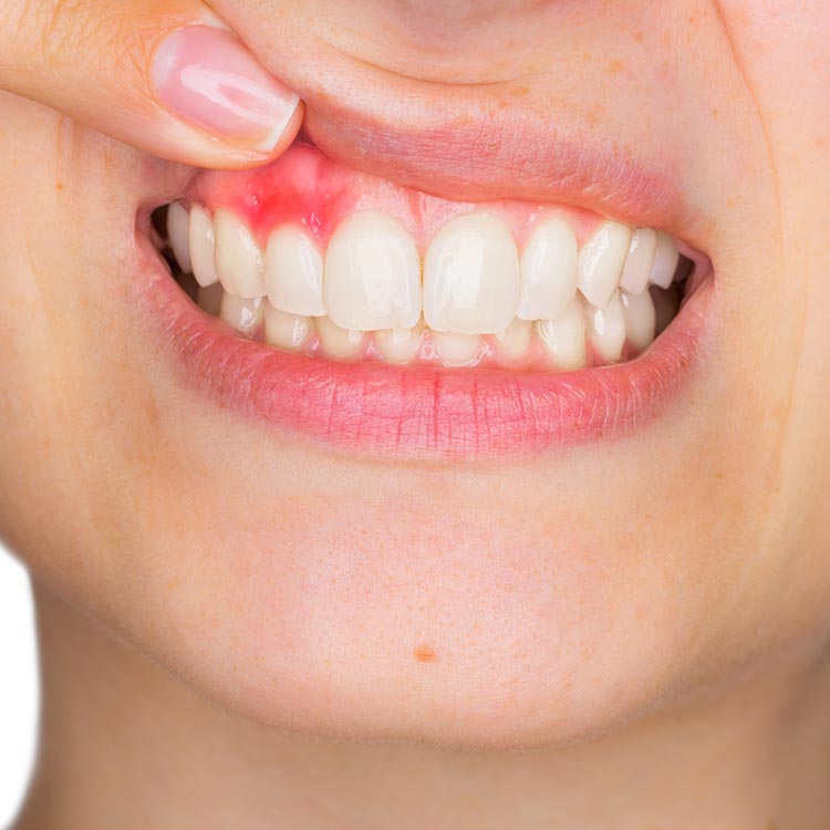 Gum Disease Treatment - Periodontics -  image