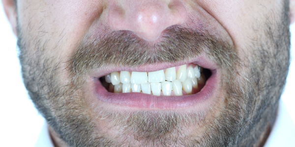 Bruxism - Teeth Grinding -  image