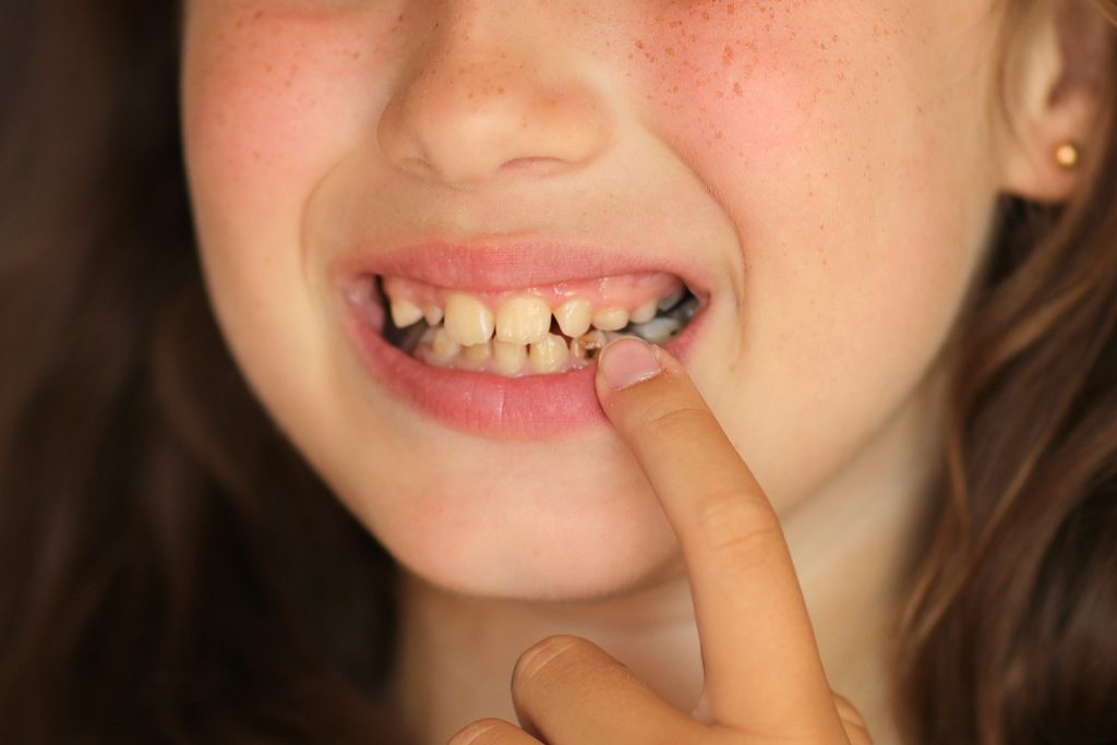 little girl opens her mouth and shows a sick tooth. caries on a baby tooth.Care for children's teeth